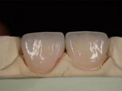 深圳義齒加工、烤瓷牙加工、全瓷牙加工、種植牙加工、牙齒加工廠